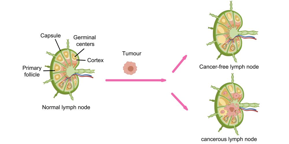 Venn_BCtype-lymphnode.jpg